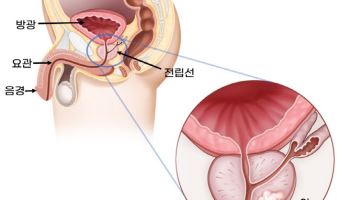 전립선암, 초기엔 대부분 증상 없어···증상 동반되면 늦어