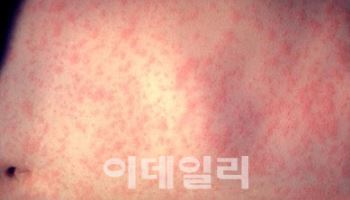 전세계 홍역 유행…출국 전 예방접종 확인하세요