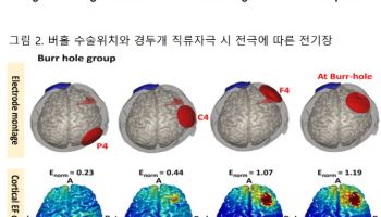 뇌질환 인지기능 저하환자, 두개골 손상되도 ‘전자약’ 치료 가능