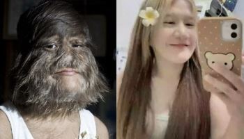 “얼굴에도 털이…” ‘늑대소녀’라 불린 20대女, 달라진 근황