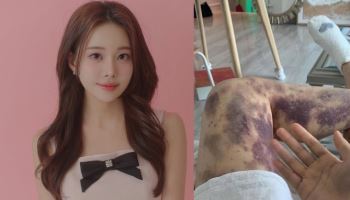 '건강주사'에 전신 피멍 아옳이…‘13억 소송’ 병원에 승소