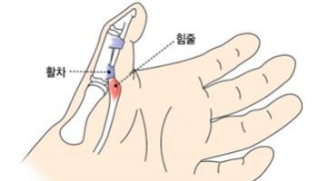 손가락에서 '딸깍' '방아쇠 손가락'... 반복되는 동작으로 발생