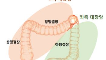 여성 대장암 절반 이상이 ‘오른쪽’... 암 발생 경로부터 달랐다