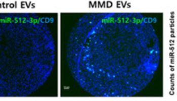 서울대병원, 혈액 검사로 소아 모야모야병 조기 진단 가능성 제시