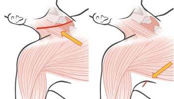 장영우 교수, GOSTA 로봇 측경부임파선곽청술 효과성 입증