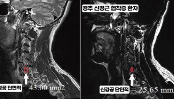가톨릭관동대 국제성모병원, 경추 신경근협착증 진단 기준 제시