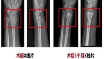 “주사 한 방이면 부러진 뼈 3분만에”…‘기적의 접착제’ 등장