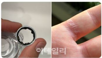 ‘갤럭시링’ 갑자기 팽창해 응급실…원인은?[모닝폰]