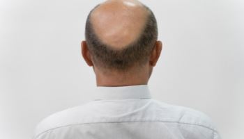 지난해 병원 찾은 탈모 환자 38% 2030…나이 많을 수록 女 비중 높아