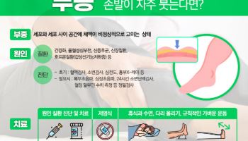 손·발이 자주 붓는다면? 신장·심장 질환 신호일 수도 있어