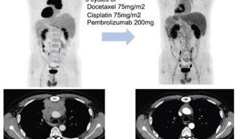 흉선암에도 면역항암제가 효과