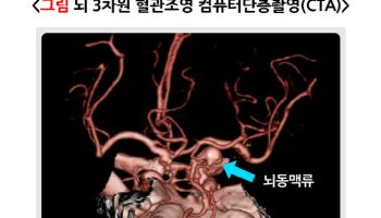 겨울철 뇌동맥류…여성이 더욱 조심해야 하는 이유
