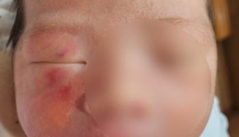 생후 4일 아기 얼굴에 상처…CCTV 없는 신생아실서 무슨 일