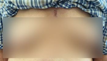 "고혈압 약 먹고 가슴 커져" 76세男 겪은 충격 부작용