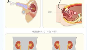  ‘요도 타들어가는 통증’ 막으면 나쁜 의사인가요