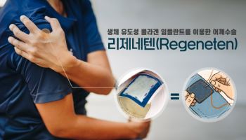 어깨 수술, 리제네텐. 동종이식물 패치로 재파열률 낮춰