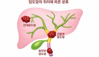 조용히 진행되는 담도암,정밀 진단과 맞춤치료가 관건
