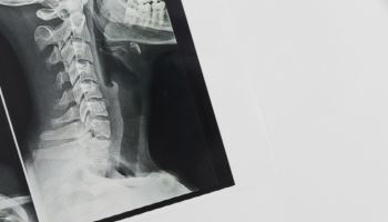 “목 디스크 수술, 그냥 퇴근”…환자는 사망