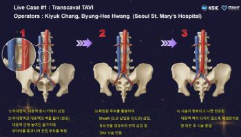서울성모병원, 국내 첫 경대정맥 대동맥 판막 치환술 실시
