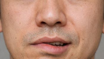 안면마비, 주변에 흔한 질환… 72시간내 치료가 회복률 높여