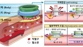 혈류 조절해 스스로 혈관 봉합하는 폐쇄장치 개발