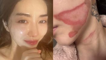 AOA 출신 권민아 "피부과 시술 도중 2도 화상" 피해 호소