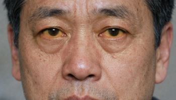 술 안 마셔도 생긴다... 간암의 흔한 원인은 술 아닌 이것