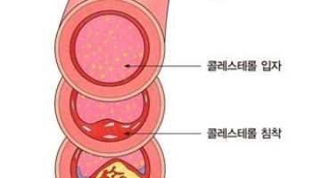 증상 없어 더 위험한 고지혈증, 지금 관리가 필요한 이유