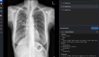 숨빗AI, 생성형 AI 흉부X선 소프트웨어 식약처 허가…의료영상 AI 상용화 탄력