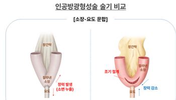 방광암 한자, 로봇 인공방광 수술 합병증 획기적으로 줄인다