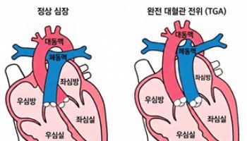 완전 대혈관 전위 환자, 수술 후 30년 생존율 89% 달성
