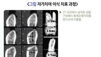 임플란트 대신 자가치아 이식술, 효과 있을까