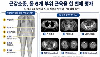 초고령사회 맞아 국내서 개발된 다영역 CT 근감소증 평가법
