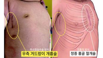'부천세종병원, 영유아 심실중격결손에 우측 겨드랑이 개흉술 성공적 시행'
