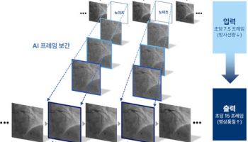 AI로 방사선량 절반 이하로 줄인 관상동맥조영술 영상 기술 개발
