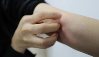 땀과 자외선, 냉방기까지…여름철 습진 주의보 발령