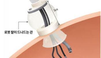 소아 복부질환에 단일공 로봇수술 적용 가능성 확인