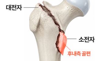 고령층 고관절 골절 수술, '뼈 맞춤'이 핵심 밝혀져