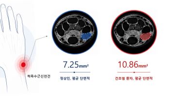 국제성모병원 김영욱 교수, 손목 힘줄염 객관적 MRI 진단 기준 제시