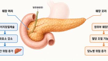 췌장 수술 후 대사질환 예방, 수술 부위별 맞춤 전략 제시