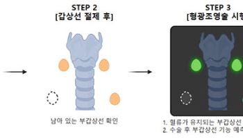 로봇 갑상선 수술 중 부갑상선 혈류 파악, 수술 후 기능저하 위험 가늠한다
