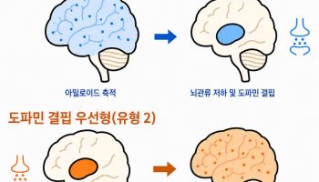 루이소체치매, 진행 경로 두 가지로 나뉘어...아밀로이드 vs 도파민 신경계
