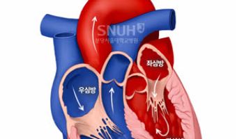 심부전 치료 후 좌심실 좋아져도  좌심방 회복 안 되면 사망 위험 3.5배