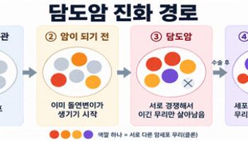 담도암, 전암 단계부터 유전자 변화…수술 후 재발은 다클론성 확인