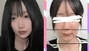 "한국서 양약수술 받고 입과 턱 마비됐다"…日인플루언서 호소