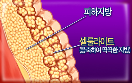 셀룰라이트, 요요현상의 악순환 고리?