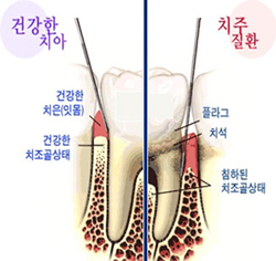 잇몸이 튼튼해야 건강한 치아