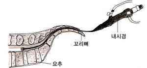 (방송예고) 척추 속을 ''내시경'' 한다고?