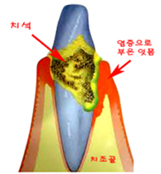 아프고 시린 스켈링, 꼭 받아야하는 건가요?