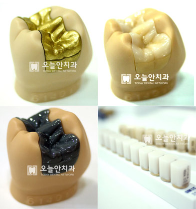 (생활상식)충치 치료, 아말감만 있는게 아니네?